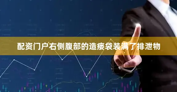 配资门户右侧腹部的造瘘袋装满了排泄物